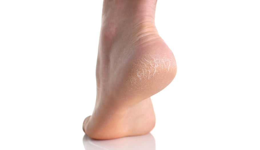 Can a Vitamin Deficiency Cause Cracked Heels ?