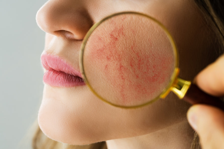 Signs and Symptoms of Rosacea
