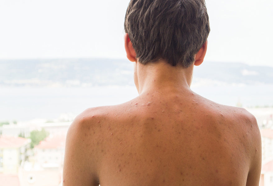 Supporting Bacne and Other Forms of Body Acne