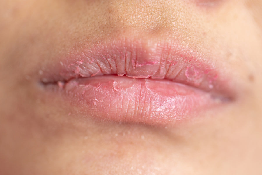 Chapped Lips and How You Can Prevent or Treat Them
