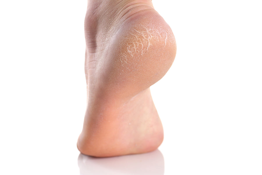 Why Can Cracked Heels Be a Problem All Year Round?