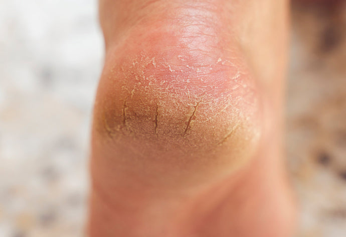 Cracked Heels? It Might Not Be Dry Skin at All