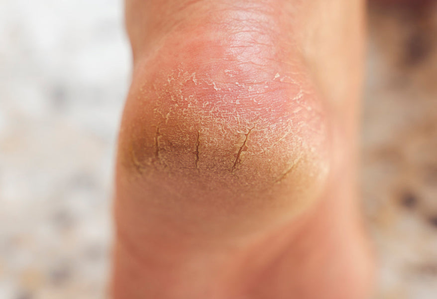 Cracked Heels? It Might Not Be Dry Skin at All