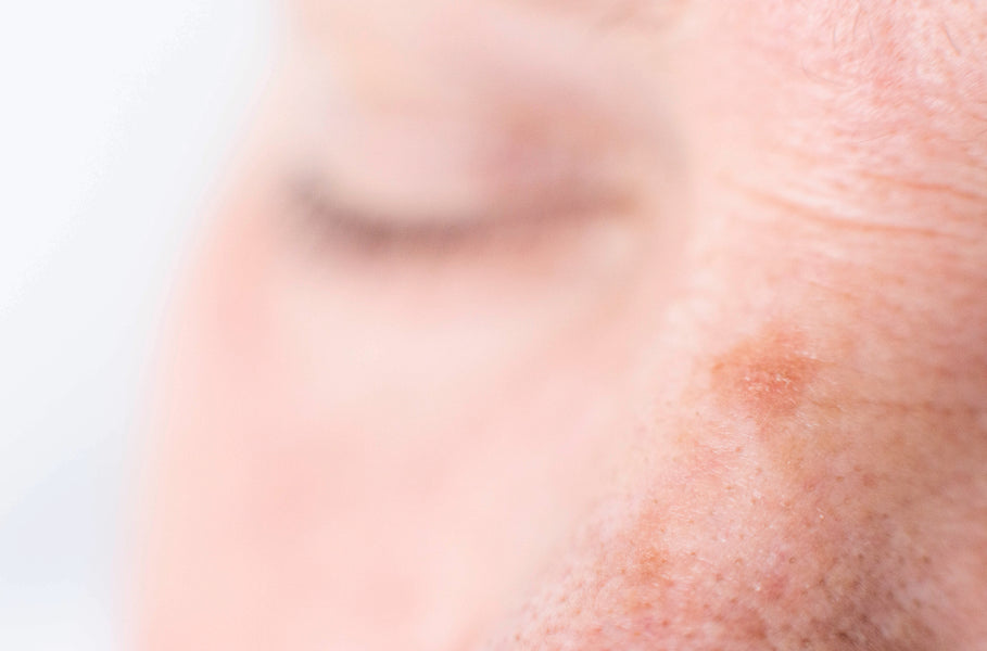 How Can You Fade Age Spots and Dark Spots Naturally?