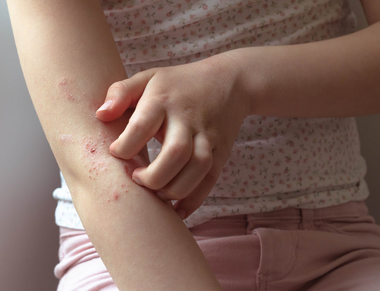 Discomfort from Rosacea or Eczema?