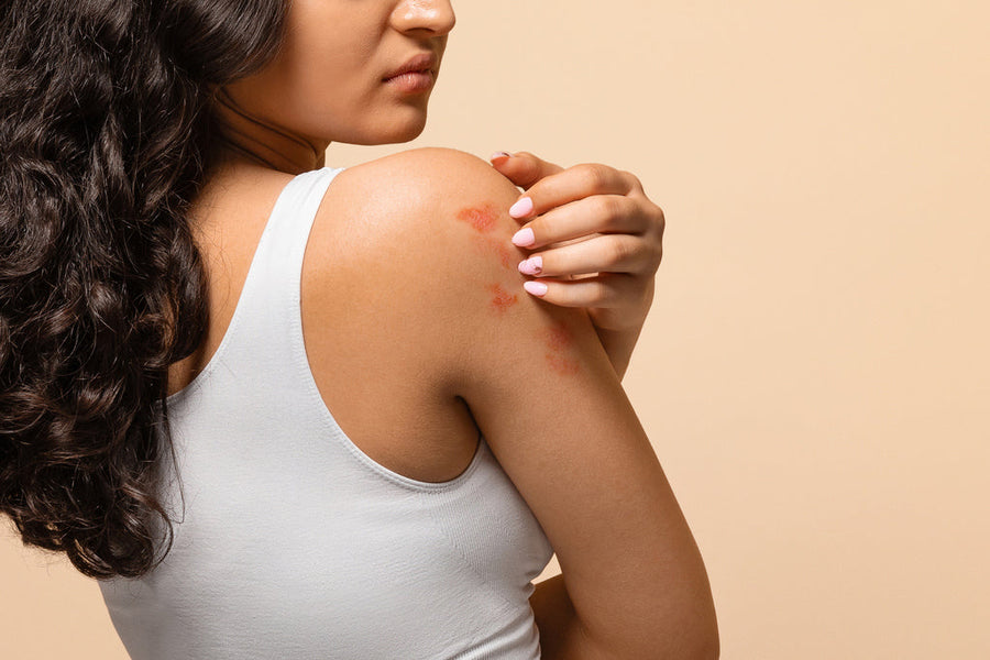 Could This Be Behind Your Eczema Flare-ups?