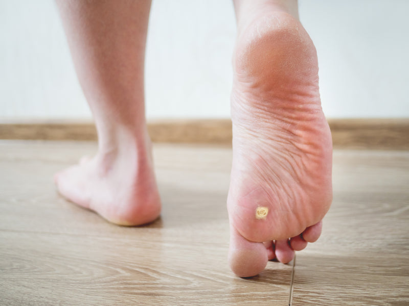 What causes warts on feet & how to get rid of feet warts?