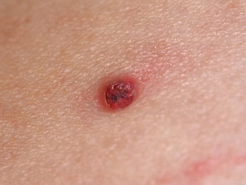 What is Granuloma Annulare and How Can This Condition Be Helped?