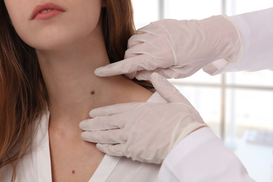 Can You Remove Moles Naturally?
