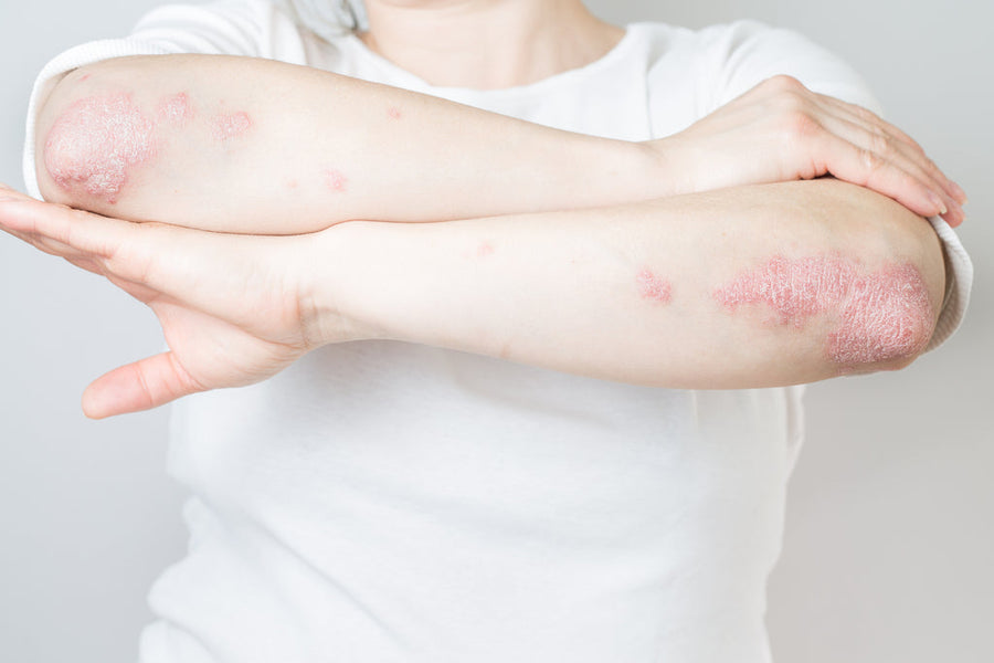 Psoriasis or Eczema?