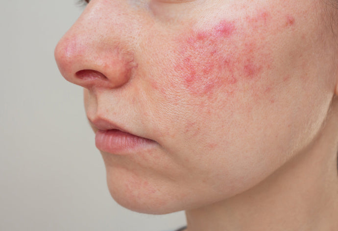 Rosacea Isn’t Just “Red Skin”