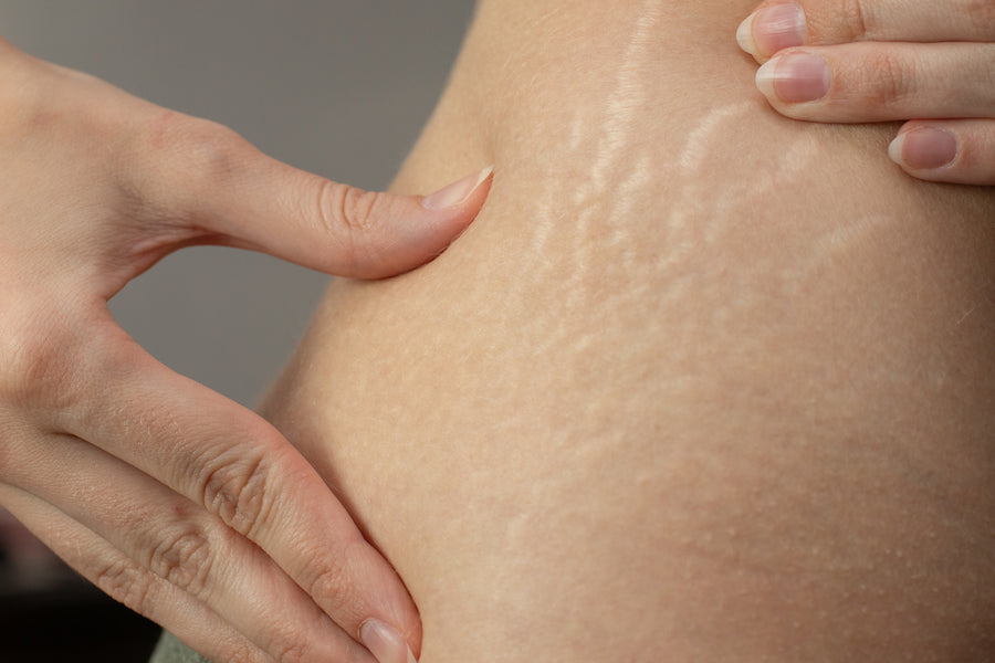 How to Cope with Stretch Marks