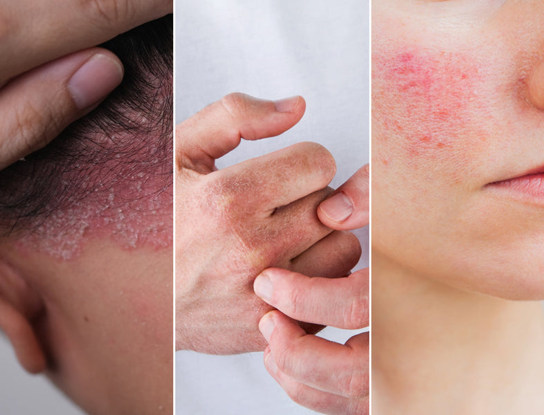 Think It’s Eczema? Read This First