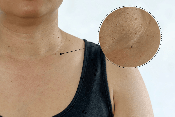Can Skin Tags Grow Back in the Same Spots?