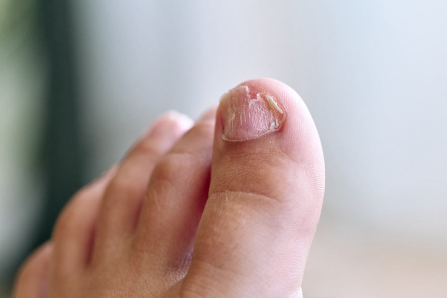 The Hidden Signs of Nail Fungus
