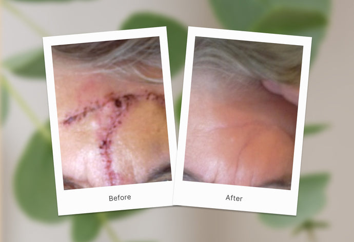 Caring for Scars One Step at a Time