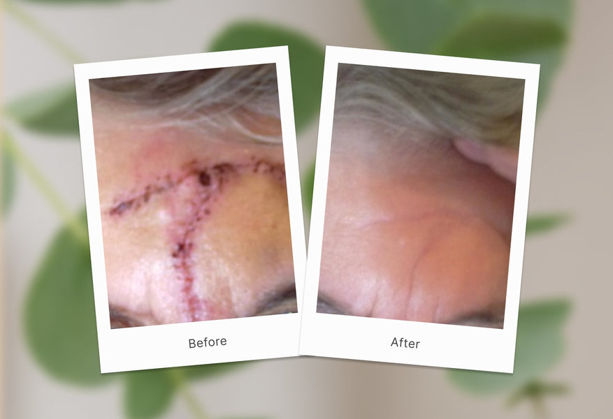 Caring for Scars One Step at a Time