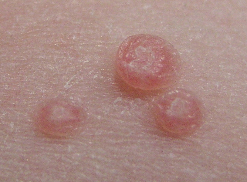 Molluscum Contagiosum & Find Out More About This Growing Viral Skin Condition