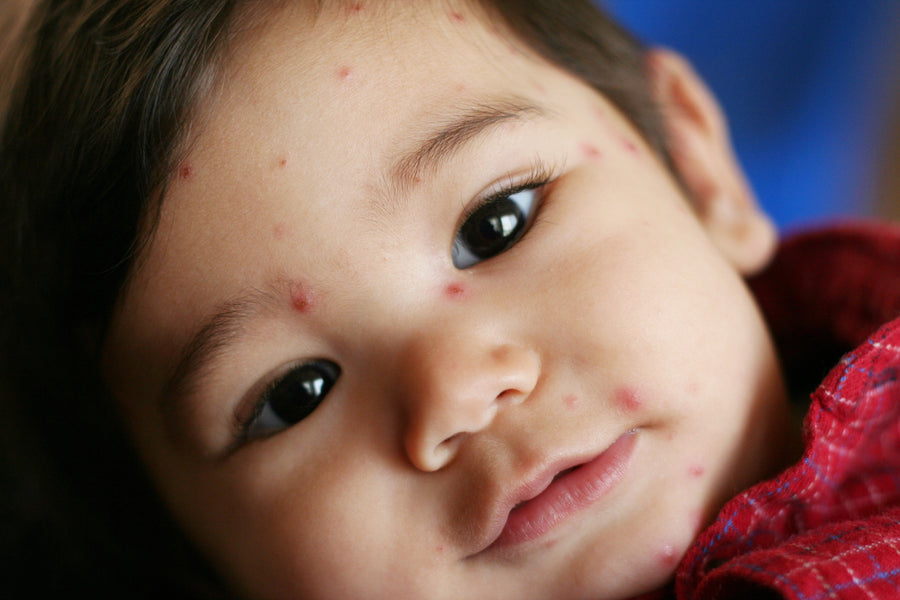 Chickenpox, Sunlight & Shingles