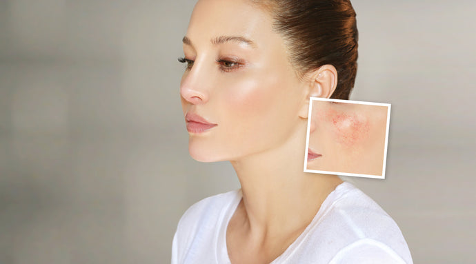 Got Psoriasis or Rosacea?