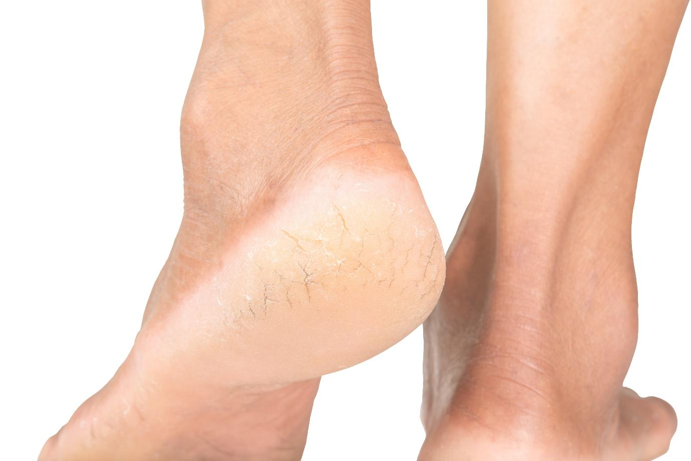 Biodeal Laboratories Limited - Don't ignore dry, cracked heels, as over  time they may develop deeper into fissures. The good news is, treating your cracked  heels doesn't have to be complicated. Dermol