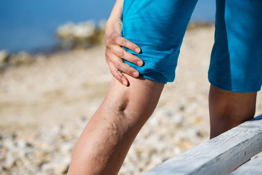Is Tattooing Your Legs a Solution to Cover Up Varicose Veins?