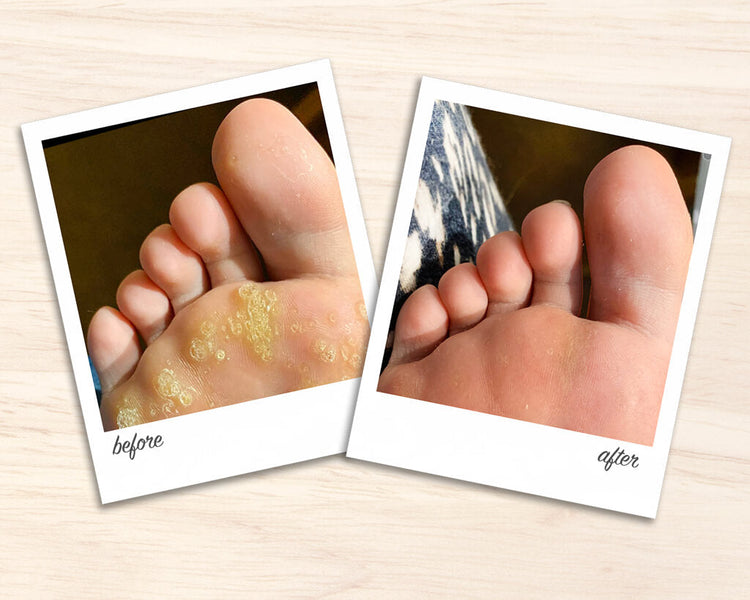 Say Goodbye to Plantar Warts Naturally (Here’s How)